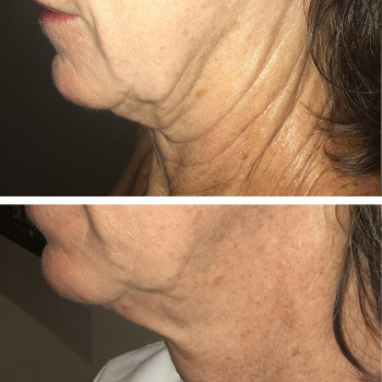 Мікроголковий РФ ліфтинг + Полікапролактон (PLC)
                    Косметологический центр  Ужгород