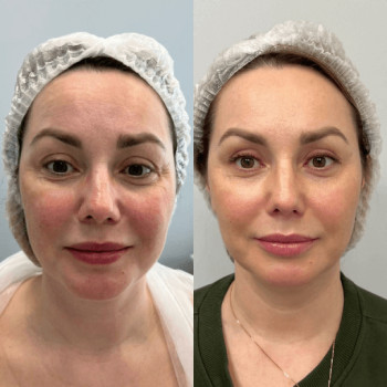 Мікроголковий РФ ліфтинг + Полікапролактон (PLC)
                    Косметологический центр  Ужгород