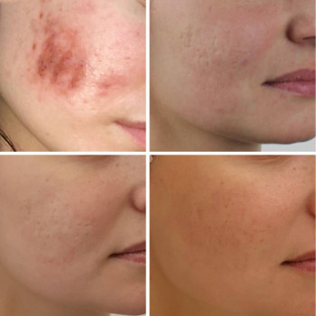 Мікроголковий РФ ліфтинг + Полікапролактон (PLC)
                    Косметологический центр  Ужгород