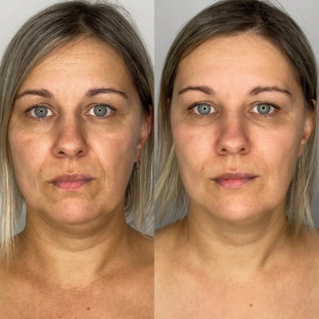 Мікроголковий РФ ліфтинг + Полікапролактон (PLC)
                    Косметологический центр  Ужгород