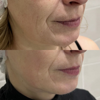 Мікроголковий РФ ліфтинг + Полікапролактон (PLC)
                    Косметологический центр  Ужгород