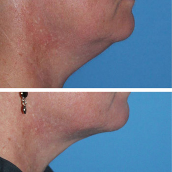 Мікроголковий РФ ліфтинг + комбінований колагеностимулятор + екзосоми
                    Косметологический центр  Ужгород