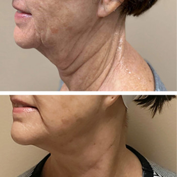 Мікроголковий РФ ліфтинг + комбінований колагеностимулятор + екзосоми
                    Косметологический центр  Ужгород