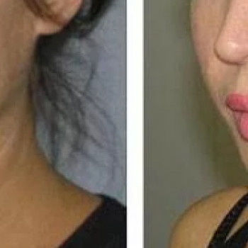 Мікроголковий РФ ліфтинг + комбінований колагеностимулятор + екзосоми
                    Косметологический центр  Ужгород