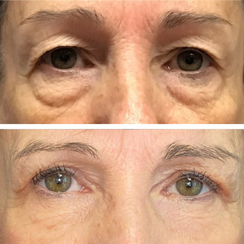 Мікроголковий РФ ліфтинг + полімолочна кислота
                    Косметологический центр  Ужгород