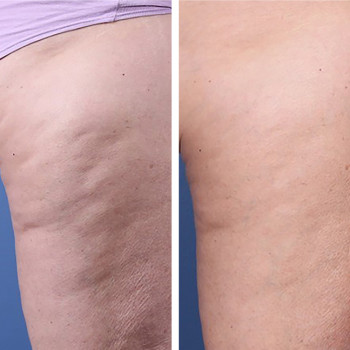 Мікроголковий РФ ліфтинг + полімолочна кислота
                    Косметологический центр  Ужгород