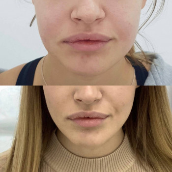 Мікроголковий РФ ліфтинг + полімолочна кислота
                    Косметологический центр  Ужгород