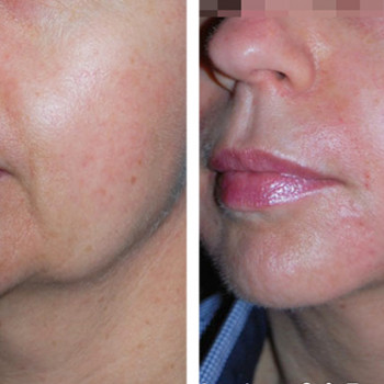 Мікроголковий РФ ліфтинг + полімолочна кислота
                    Косметологический центр  Ужгород