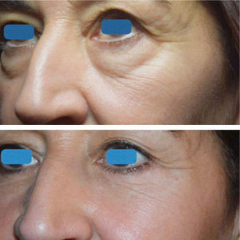 Мікроголковий РФ ліфтинг + полімолочна кислота
                    Косметологический центр  Ужгород