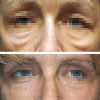 Мікроголковий РФ ліфтинг + полімолочна кислота
                    Косметологический центр  Ужгород