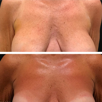 Мікроголковий РФ ліфтинг + полімолочна кислота
                    Косметологический центр  Ужгород