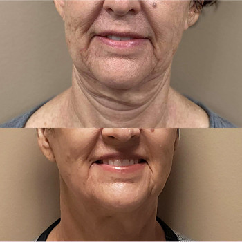 Мікроголковий РФ ліфтинг + полімолочна кислота
                    Косметологический центр  Ужгород