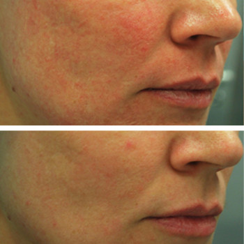 Мікроголковий РФ ліфтинг + полімолочна кислота
                    Косметологический центр  Ужгород