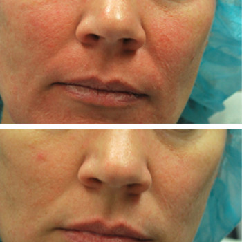 Мікроголковий РФ ліфтинг + полімолочна кислота
                    Косметологический центр  Ужгород