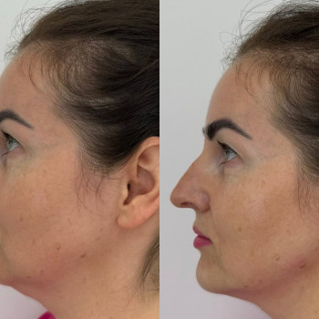 Мікроголковий РФ ліфтинг + полімолочна кислота
                    Косметологический центр  Ужгород