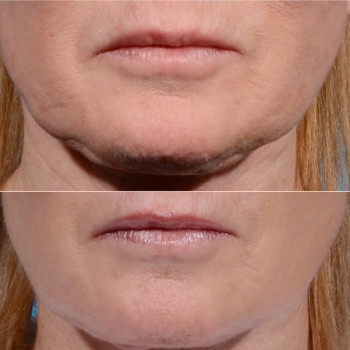 Мікроголковий РФ ліфтинг + полімолочна кислота
                    Косметологический центр  Ужгород