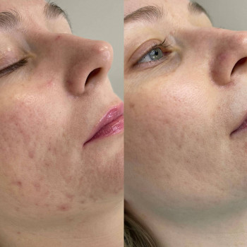 Мікроголковий РФ ліфтинг + полімолочна кислота
                    Косметологический центр  Ужгород