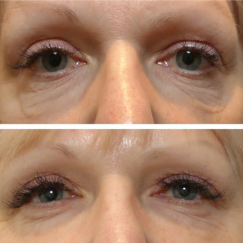 Мікроголковий РФ ліфтинг + полімолочна кислота
                    Косметологический центр  Ужгород