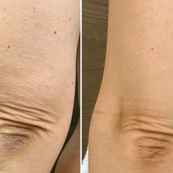 Мікроголковий РФ ліфтинг + полімолочна кислота
                    Косметологический центр  Ужгород