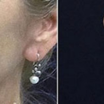 Мікроголковий РФ ліфтинг + полінуклеотиди
                    Косметологический центр  Ужгород