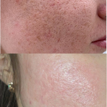 Мікроголковий РФ ліфтинг + полінуклеотиди
                    Косметологический центр  Ужгород