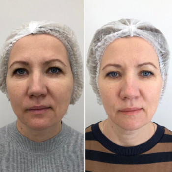 Мікроголковий РФ ліфтинг + полінуклеотиди
                    Косметологический центр  Ужгород