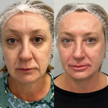 Мікроголковий РФ ліфтинг + полінуклеотиди
                    Косметологический центр  Ужгород