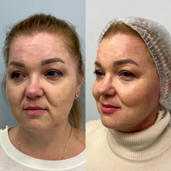 Мікроголковий РФ ліфтинг + полінуклеотиди
                    Косметологический центр  Ужгород