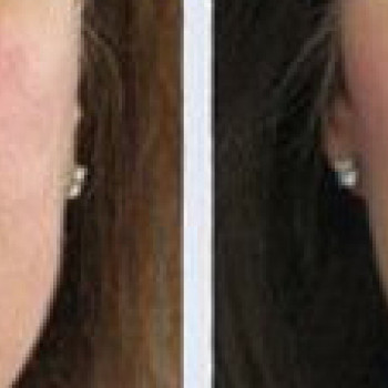 Мікроголковий РФ ліфтинг + полінуклеотиди
                    Косметологический центр  Ужгород