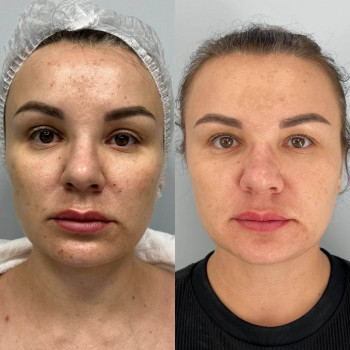 Мікроголковий РФ ліфтинг + полінуклеотиди
                    Косметологический центр  Ужгород