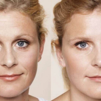 Мікроголковий РФ ліфтинг + полінуклеотиди
                    Косметологический центр  Ужгород