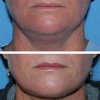 Мікроголковий РФ ліфтинг + полінуклеотиди
                    Косметологический центр  Ужгород