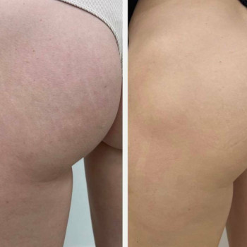 Мікроголковий РФ ліфтинг сідниці+стегна
                    Косметологический центр  Ужгород