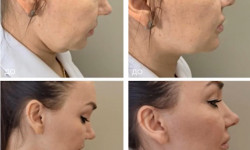 Мікроголковий РФ ліфтинг руки+шия+декольте Косметологический центр  Ужгород