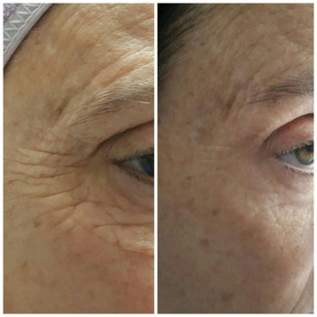 Мікроголковий РФ ліфтинг верхньої половини обличчя
                    Косметологический центр  Ужгород