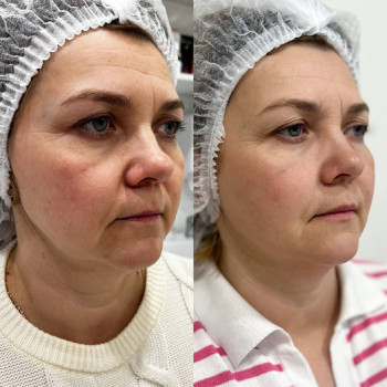 Мікроголковий РФ ліфтинг верхньої половини обличчя
                    Косметологический центр  Ужгород