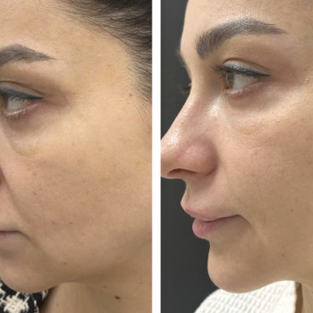 Мікроголковий РФ ліфтинг верхньої половини обличчя
                    Косметологический центр  Ужгород