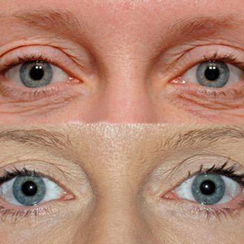 Мікроголковий РФ ліфтинг верхньої половини обличчя
                    Косметологический центр  Ужгород