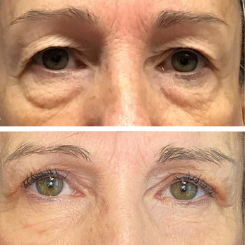 Мікроголковий РФ ліфтинг верхньої половини обличчя
                    Косметологический центр  Ужгород