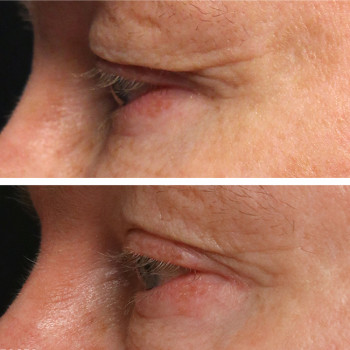 Мікроголковий РФ ліфтинг верхньої половини обличчя
                    Косметологический центр  Ужгород