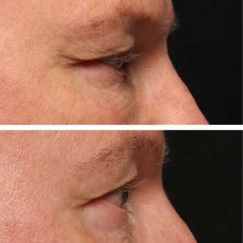 Мікроголковий РФ ліфтинг верхньої половини обличчя
                    Косметологический центр  Ужгород