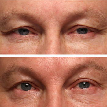 Мікроголковий РФ ліфтинг верхньої половини обличчя
                    Косметологический центр  Ужгород