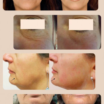 Мікроголковий РФ ліфтинг верхньої половини обличчя
                    Косметологический центр  Ужгород