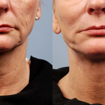 Мікроголковий РФ ліфтинг нижньої половини обличчя
                    Косметологический центр  Ужгород