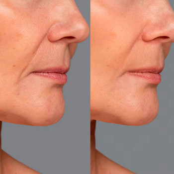 Мікроголковий РФ ліфтинг нижньої половини обличчя
                    Косметологический центр  Ужгород