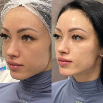 Мікроголковий РФ ліфтинг нижньої половини обличчя
                    Косметологический центр  Ужгород