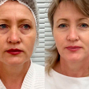 Мікроголковий РФ ліфтинг нижньої половини обличчя
                    Косметологический центр  Ужгород