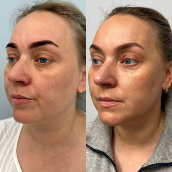 Мікроголковий РФ ліфтинг нижньої половини обличчя
                    Косметологический центр  Ужгород