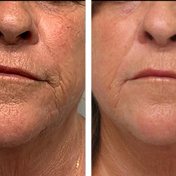 Мікроголковий РФ ліфтинг нижньої половини обличчя
                    Косметологический центр  Ужгород