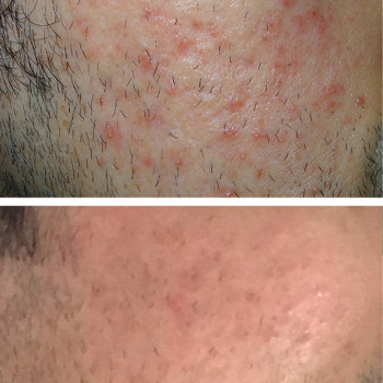 Мікроголковий РФ ліфтинг нижньої половини обличчя
                    Косметологический центр  Ужгород